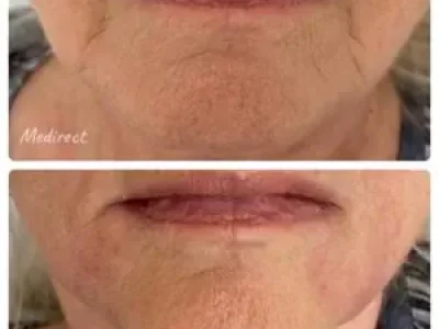 Medirect - esteticka medicina - vyhladenie vrasok 4