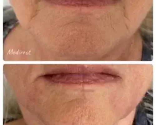 Medirect - esteticka medicina - vyhladenie vrasok 4
